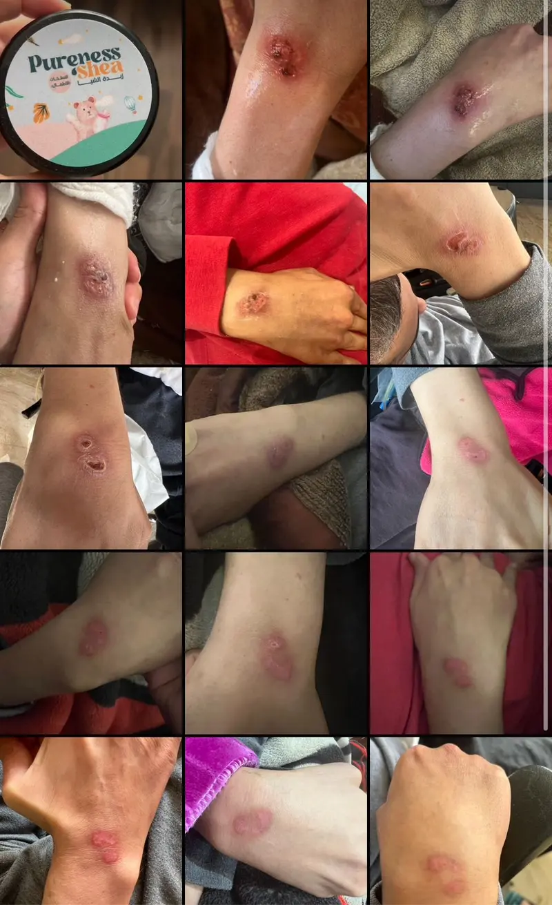 ⁦زبدة الشيا لعلاج تسلخات الأطفال⁩ - الصورة ⁦3⁩